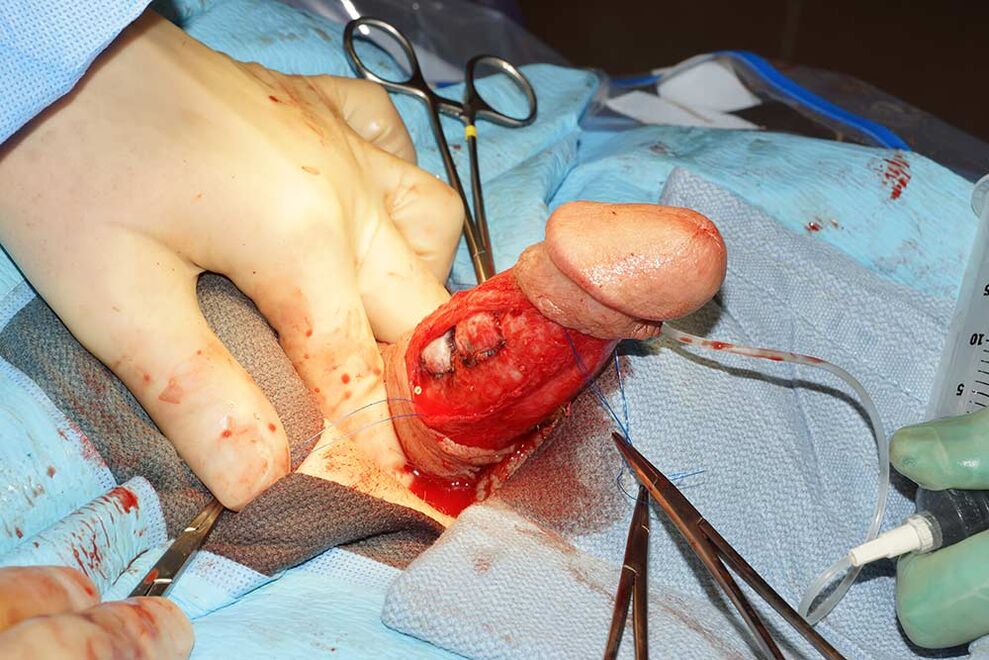 penis enlargement surgery