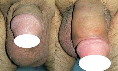 Photo before and after the penis rise
