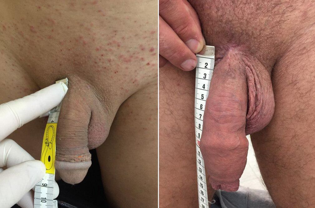 before and after penile surgery
